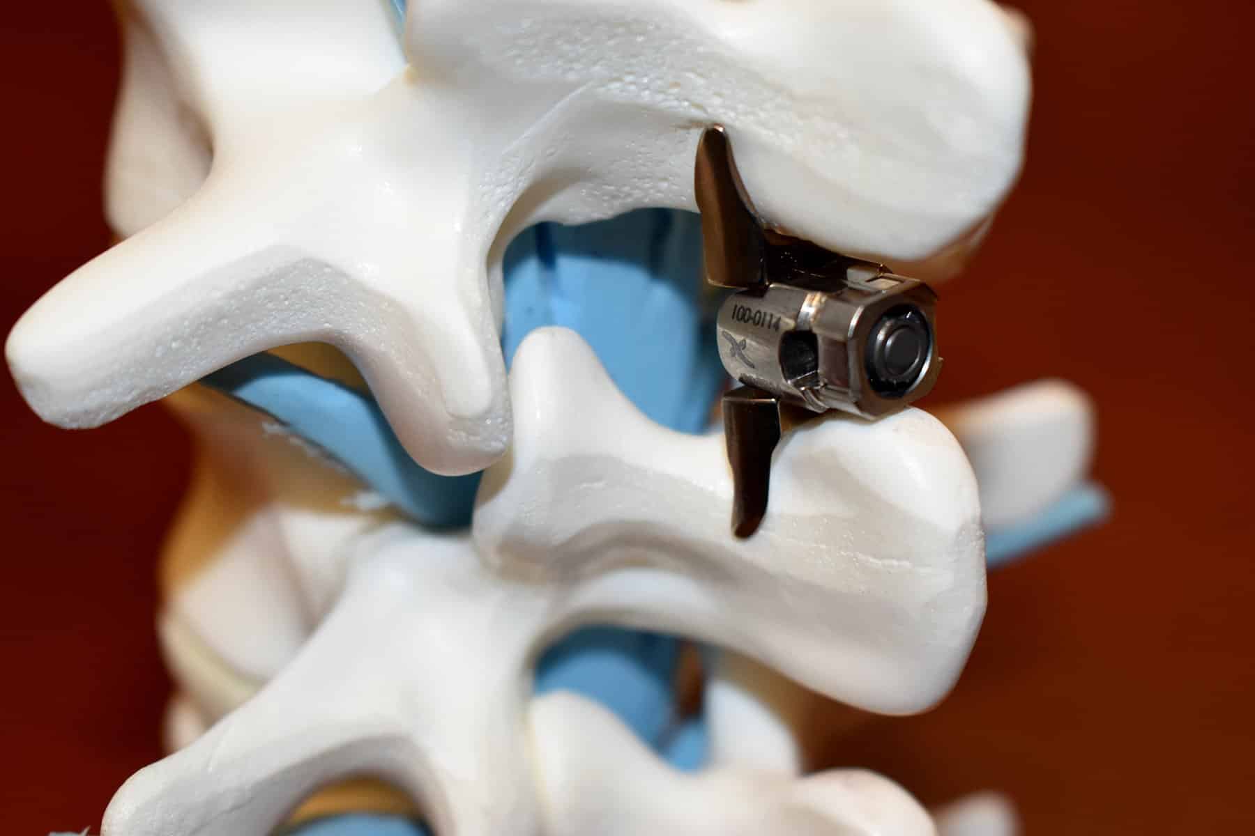 New Vertiflex Interspinal Spacer Procedure Eaton Rapids Medical Center